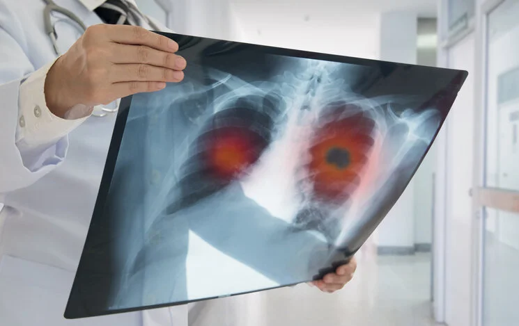 New study’s message: Quit smoking now to improve chances of surviving a diagnosis of lung cancer