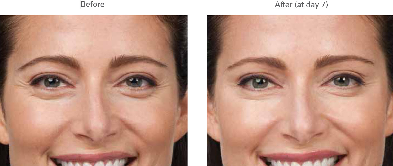 Botox Glabella injection photos