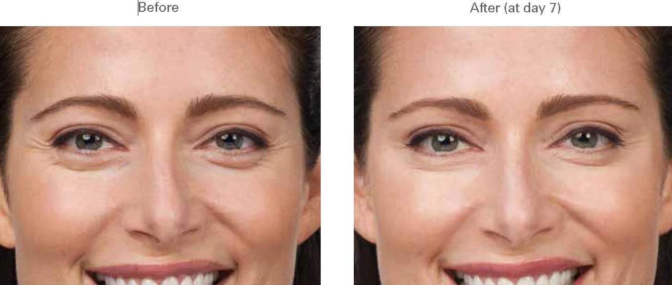 Botox Remove Wrinkles Crows Feet Between Eyes Forehead