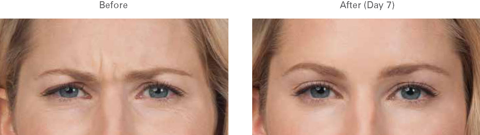 Botox photograph illustrating fewer wrinkles