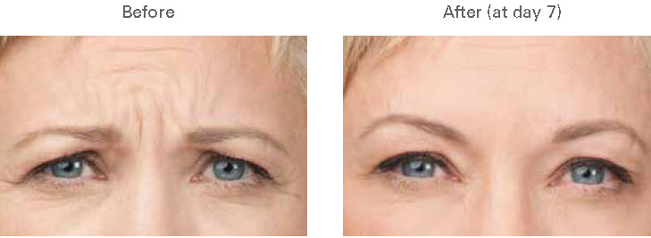 Botox before and after photograph