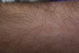 *Results Vary. Laser Hair Removal on Arm before picture