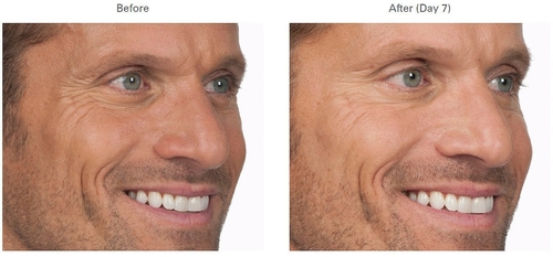 * Results vary. Botox in Men Before and After Photos 1