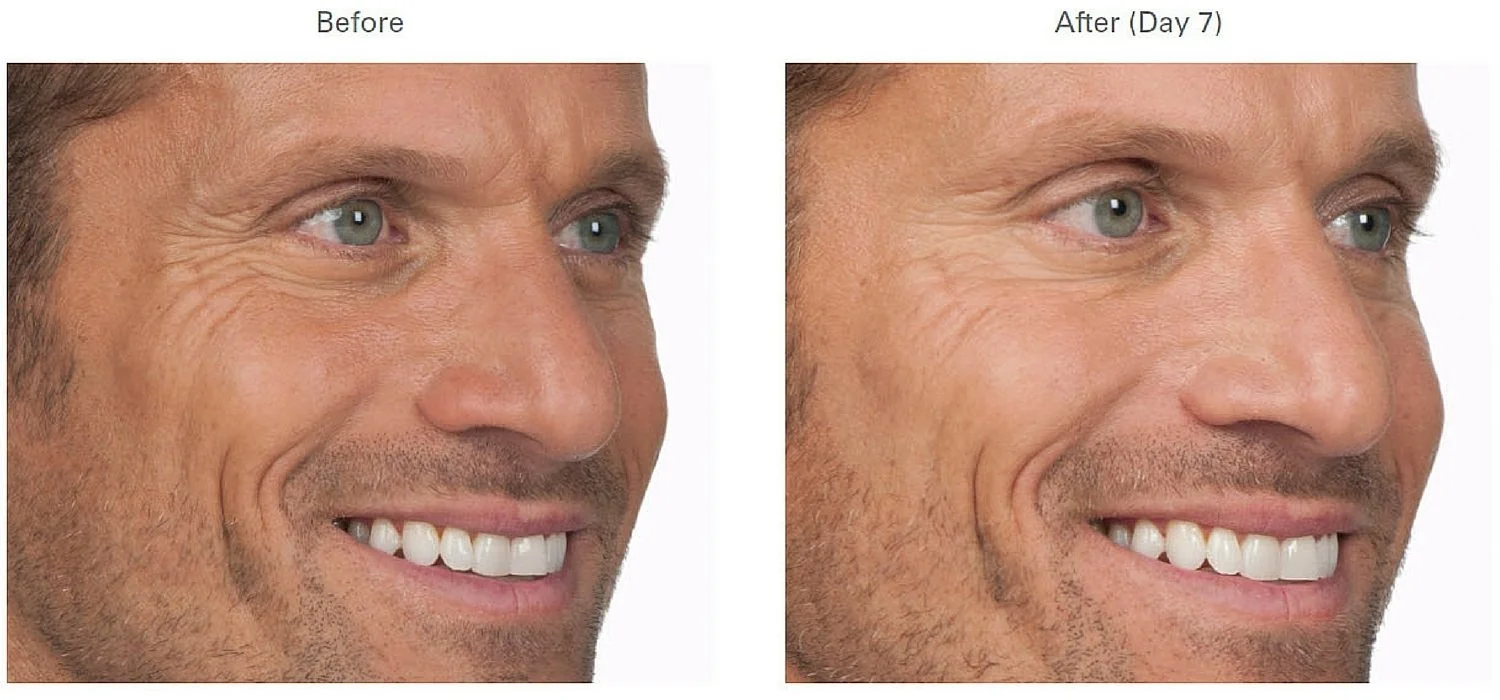 Botox for Men | Forehead, Crow's Feet, Lines Between Eyes ... Botox for Men | Forehead, Crow's Feet, Lines Between Eyes ...