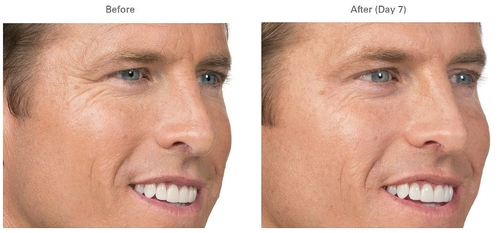 Botox before and after photos in man v2