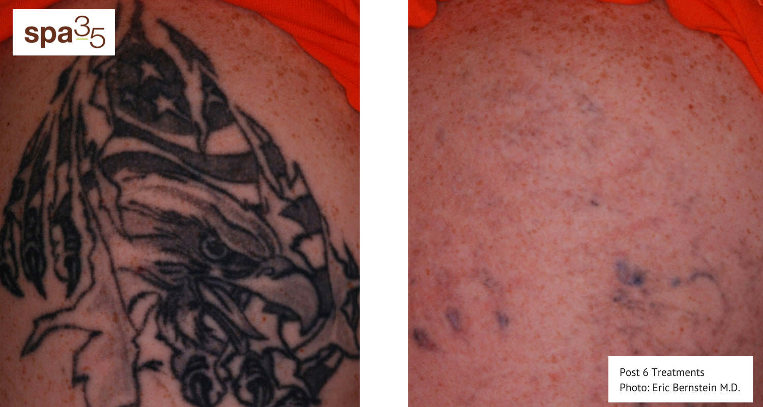 Tattoo Removal  Dermalase Medical Spa Ocala