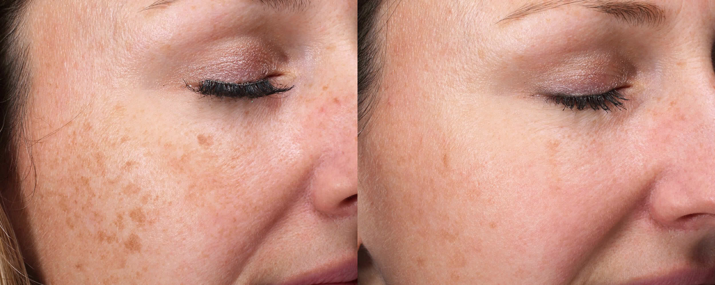 How To Remove Age Spots Tunersread how-to-remove-age-spots-tunersread