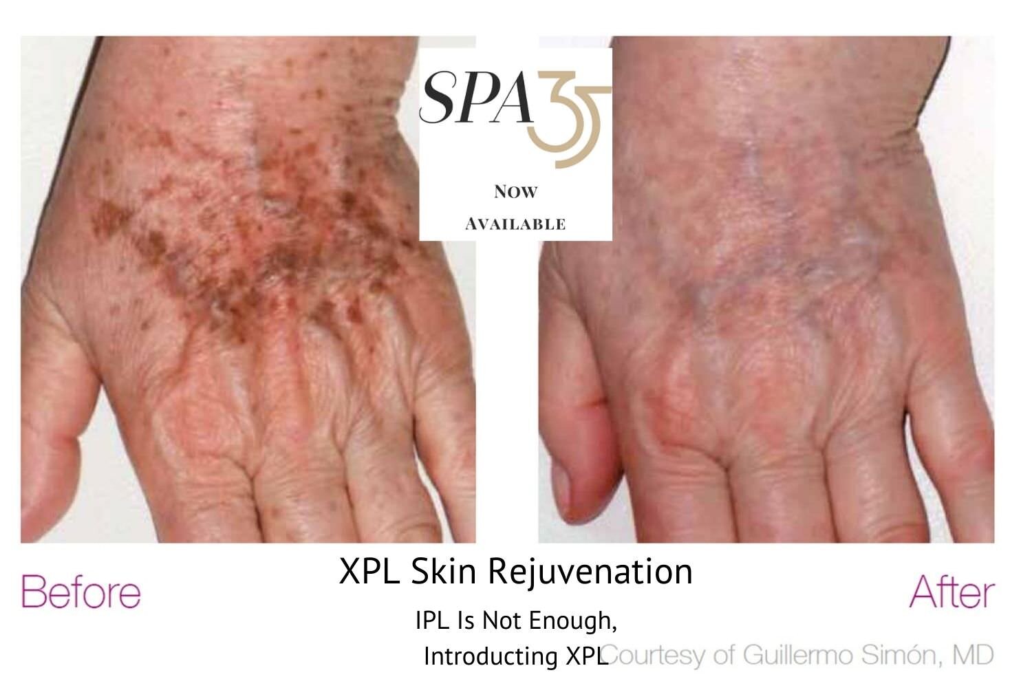 Ipl Treatment In Boise Idaho Age Spots Redness Reduction Spa 35