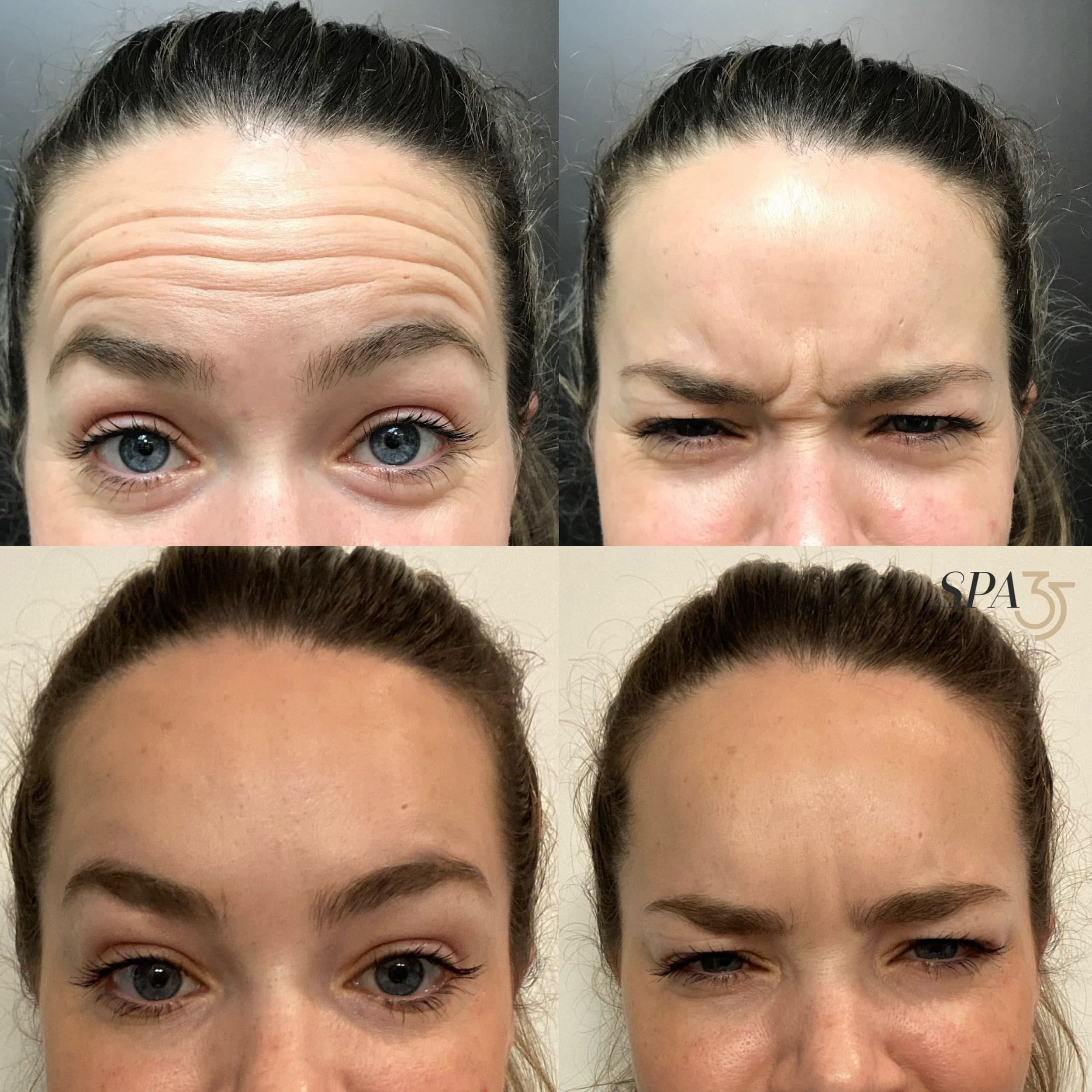 Botox Dysport in Forehead