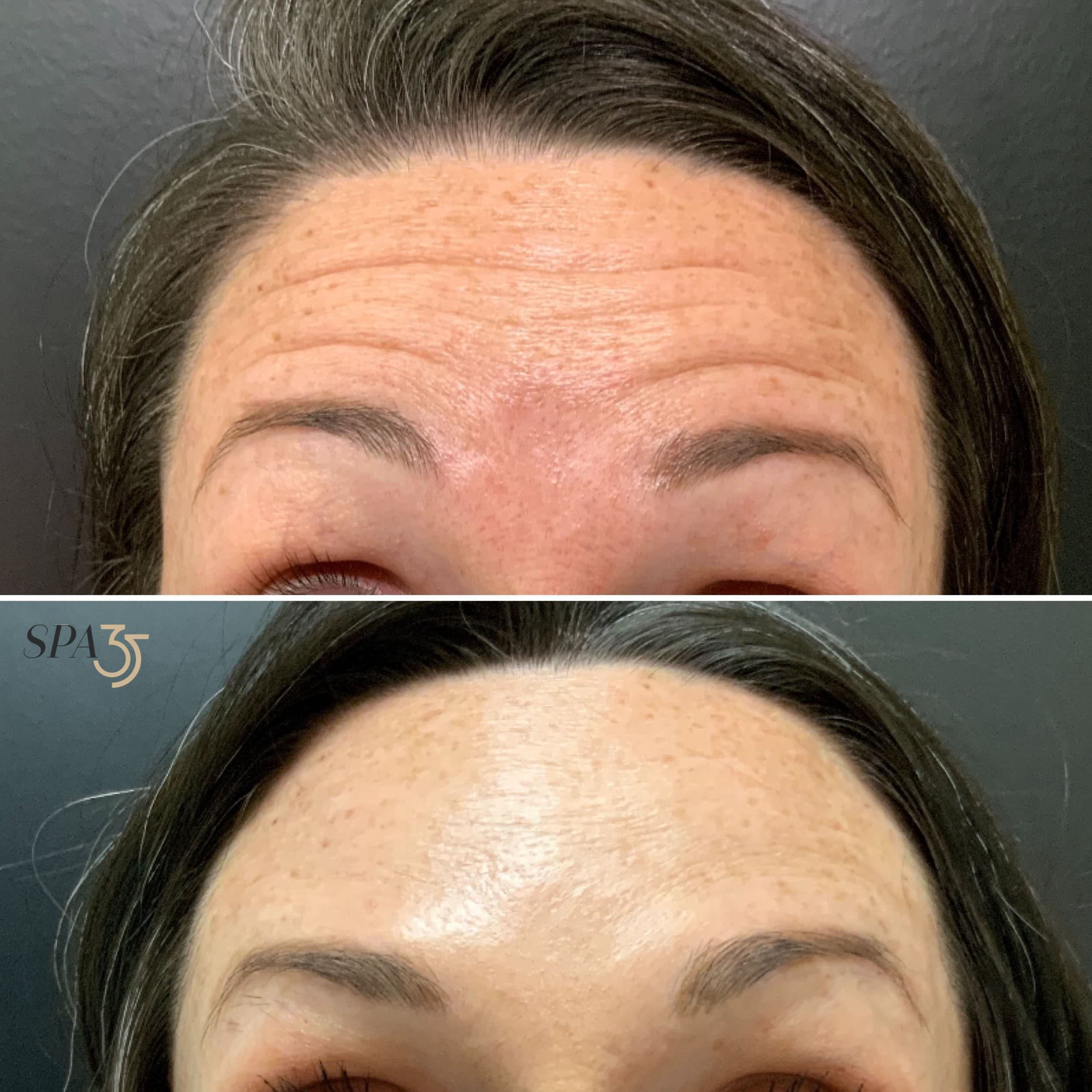 Botox Forehead 2 at Spa 35 in Boise.jpg