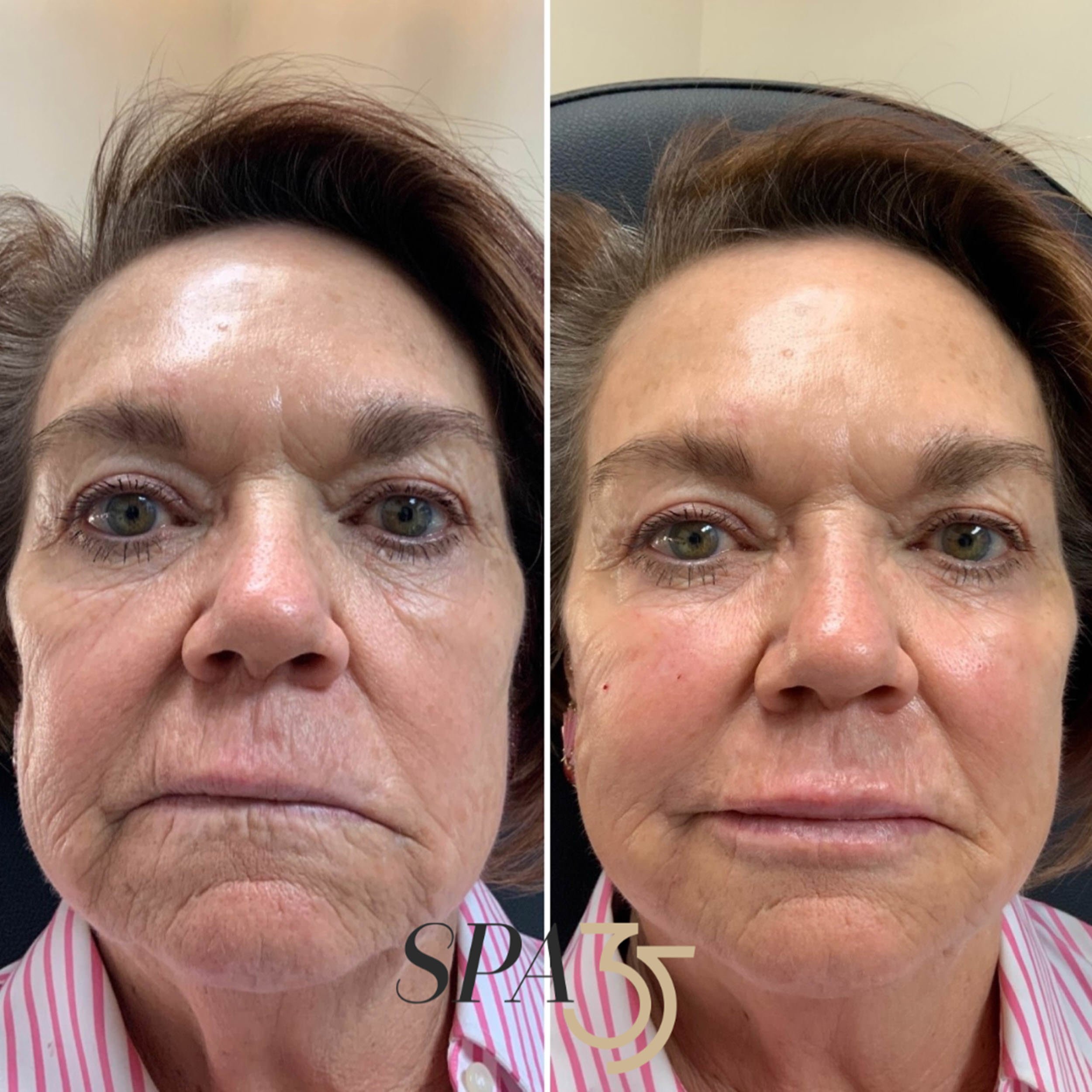 Dermal Fillers 1 Full Face