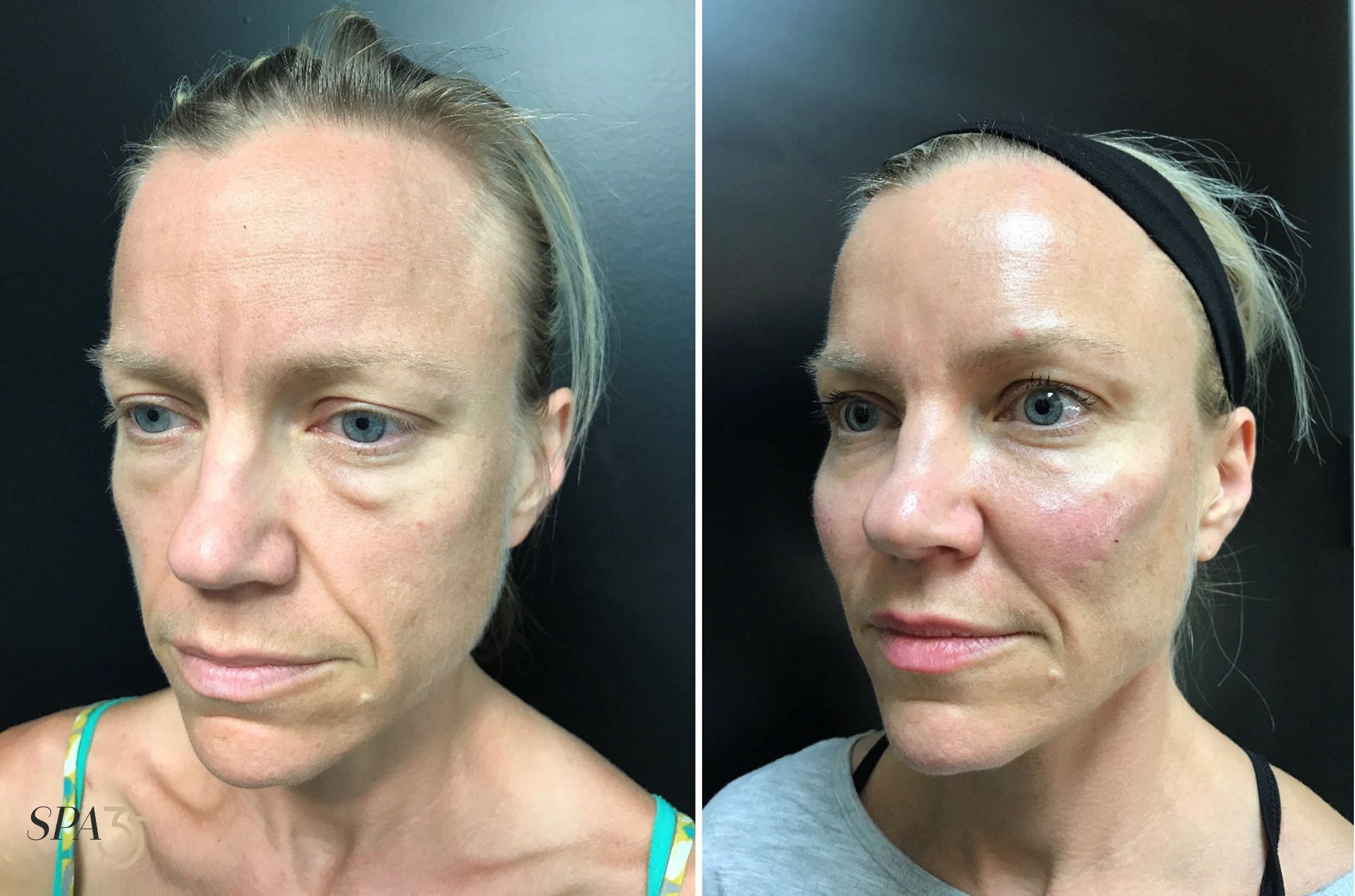 Voluma Juvederm Dermal Filler Before and After Photo 5