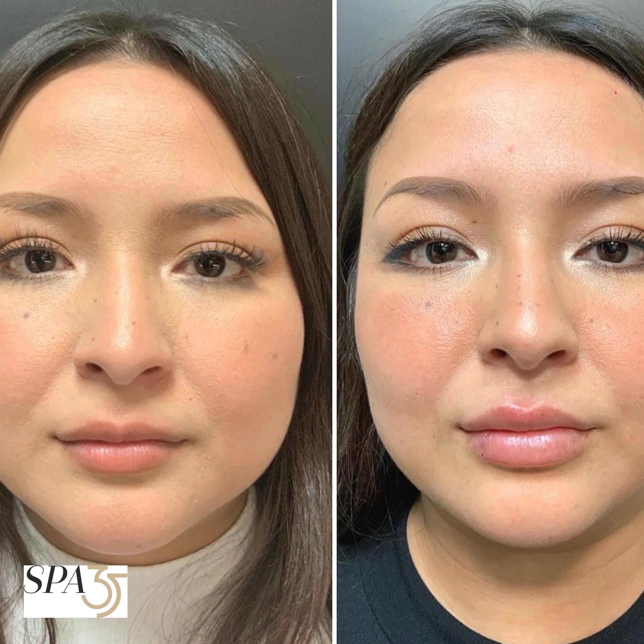 Before and after photos of dermal filler lip injections at Spa 35 Medical Spa