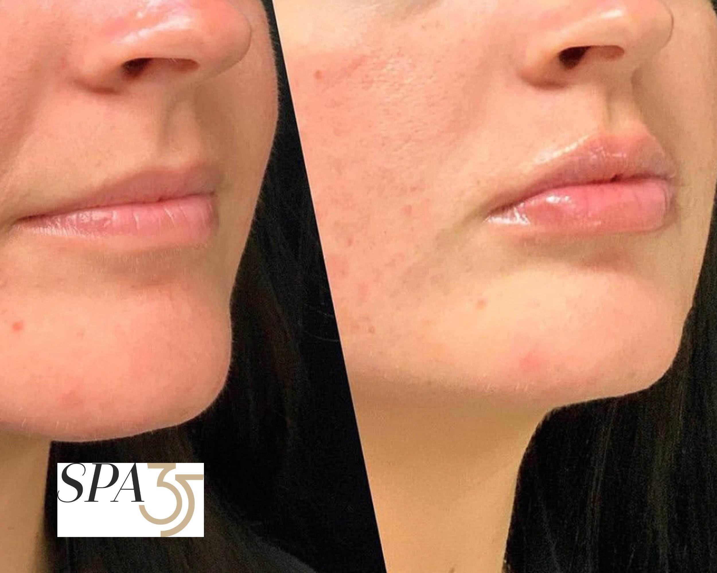 Kysse and Juvederm are popular lip injection dermal fillers