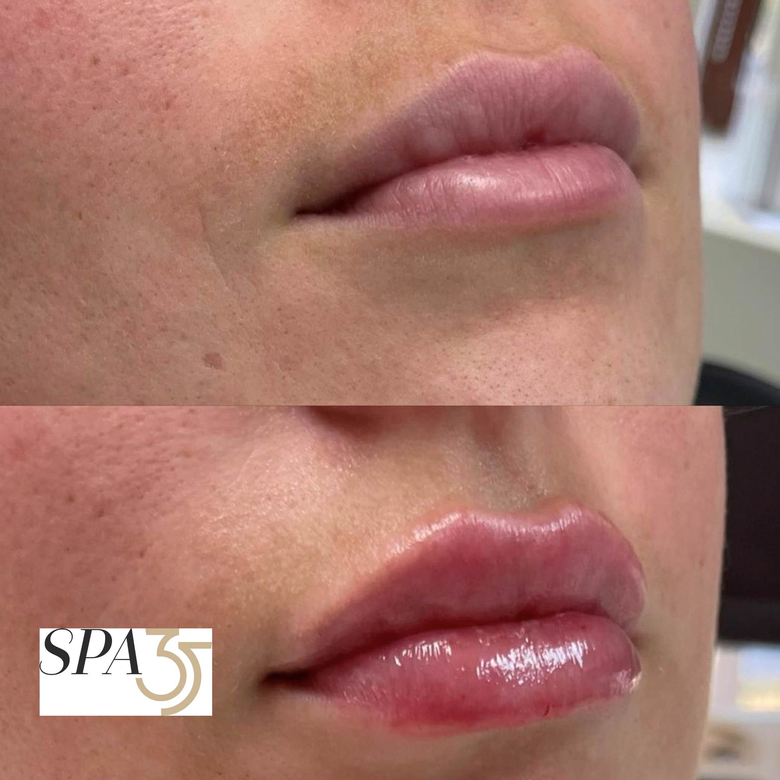 Lip Injections Before and After Photos 2 Spa 35