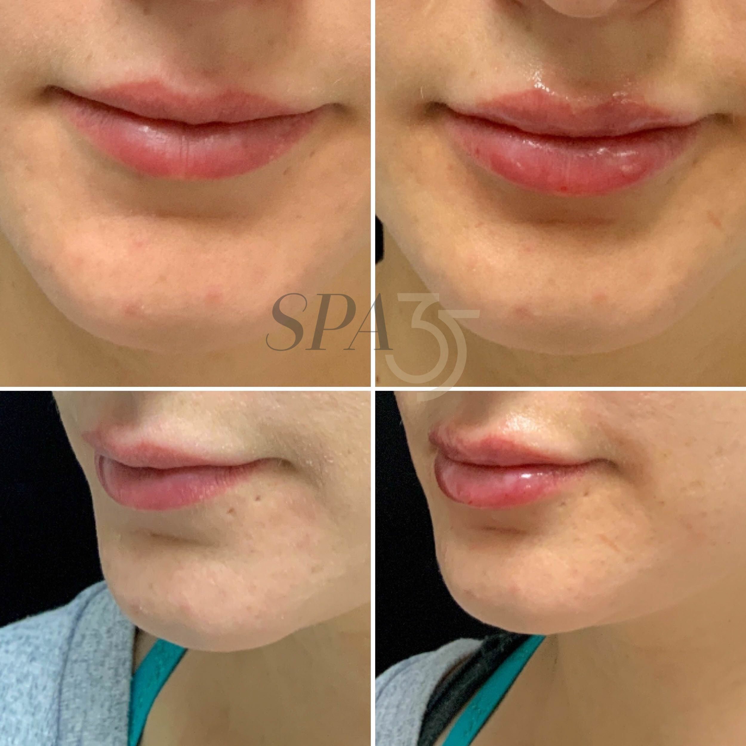 Lip injections Before and After photos