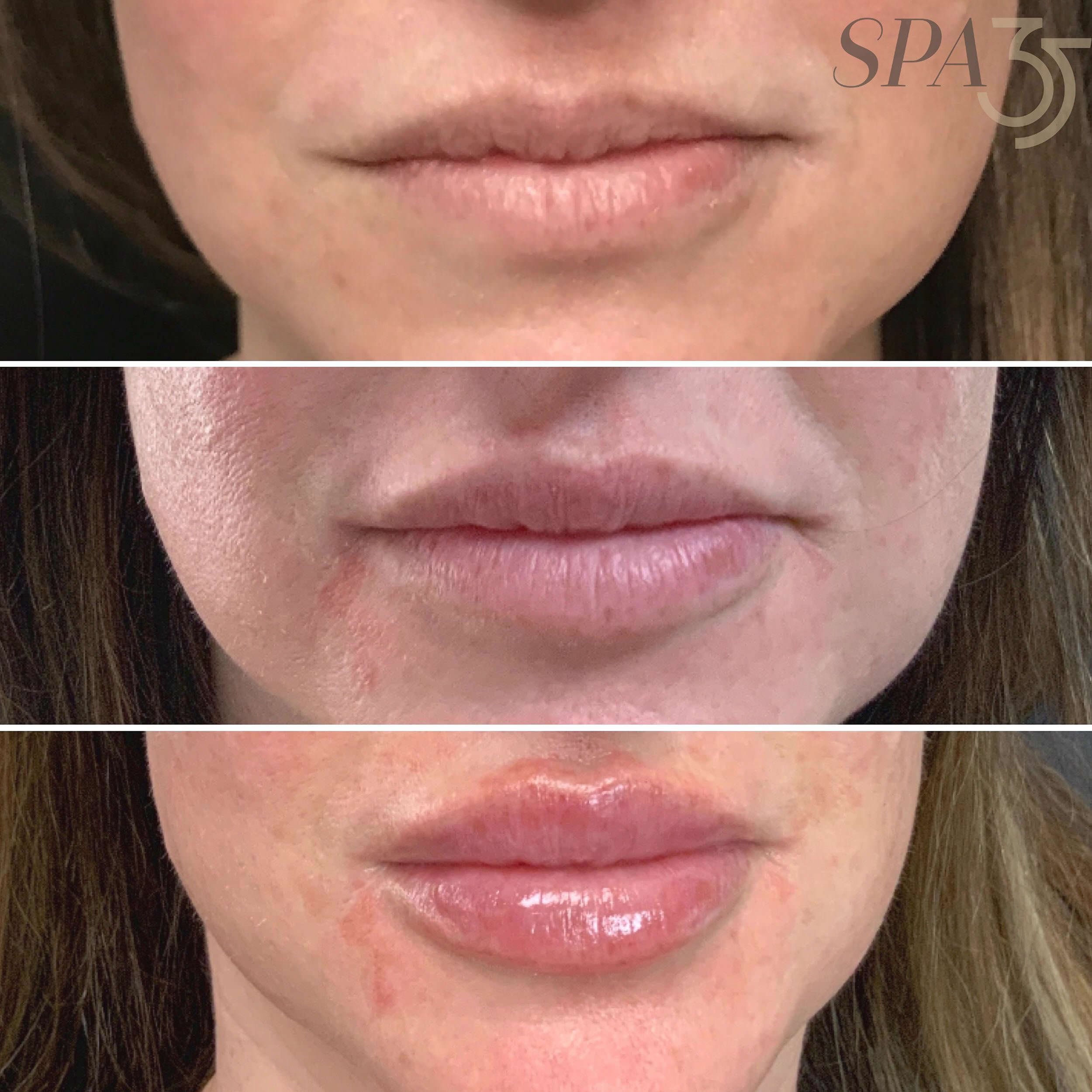 Dermal Filler Lip Injections before and after photos