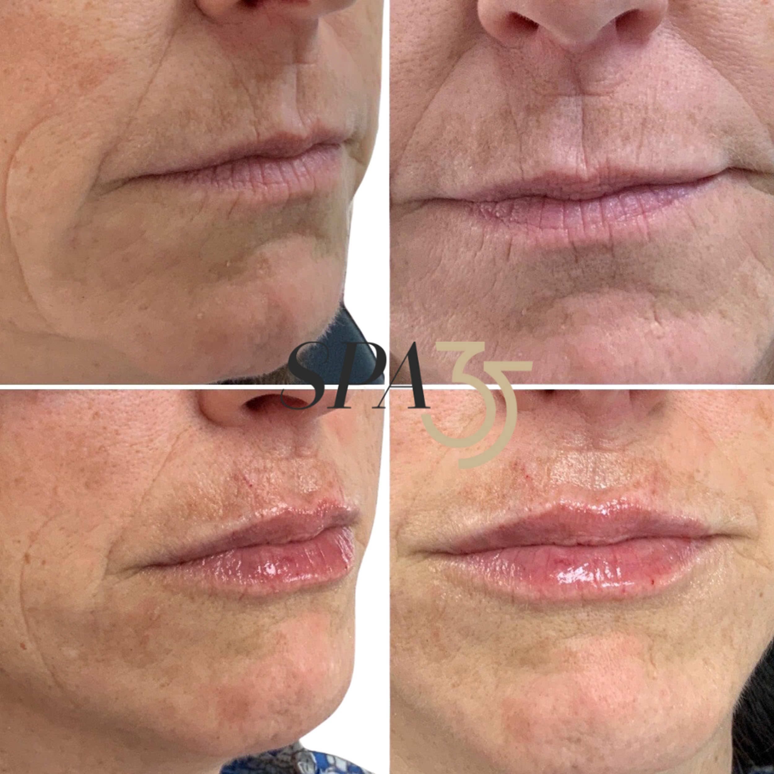 Before and after photos of hyaluronic acid based dermal fillers