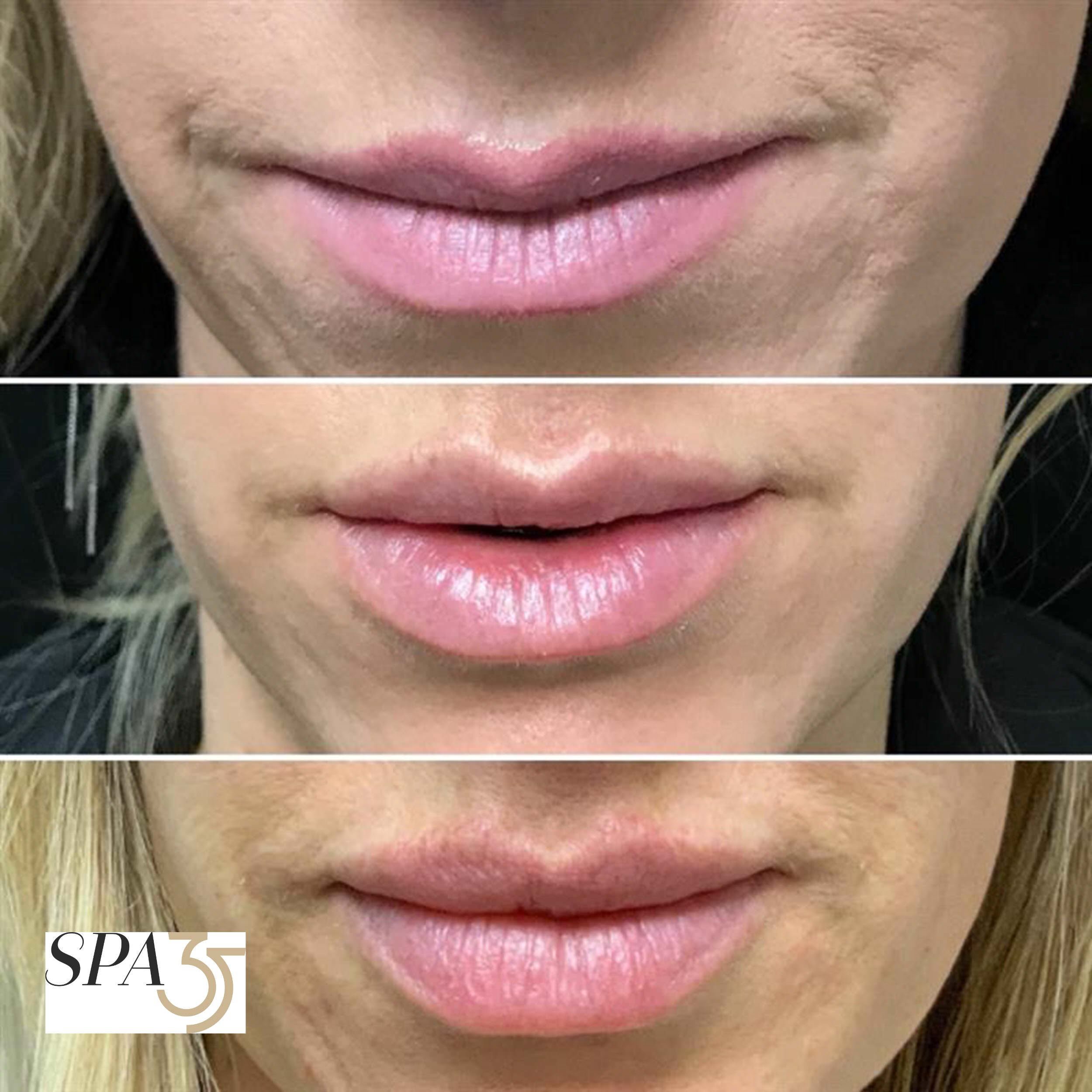 Lip injection before and after photos