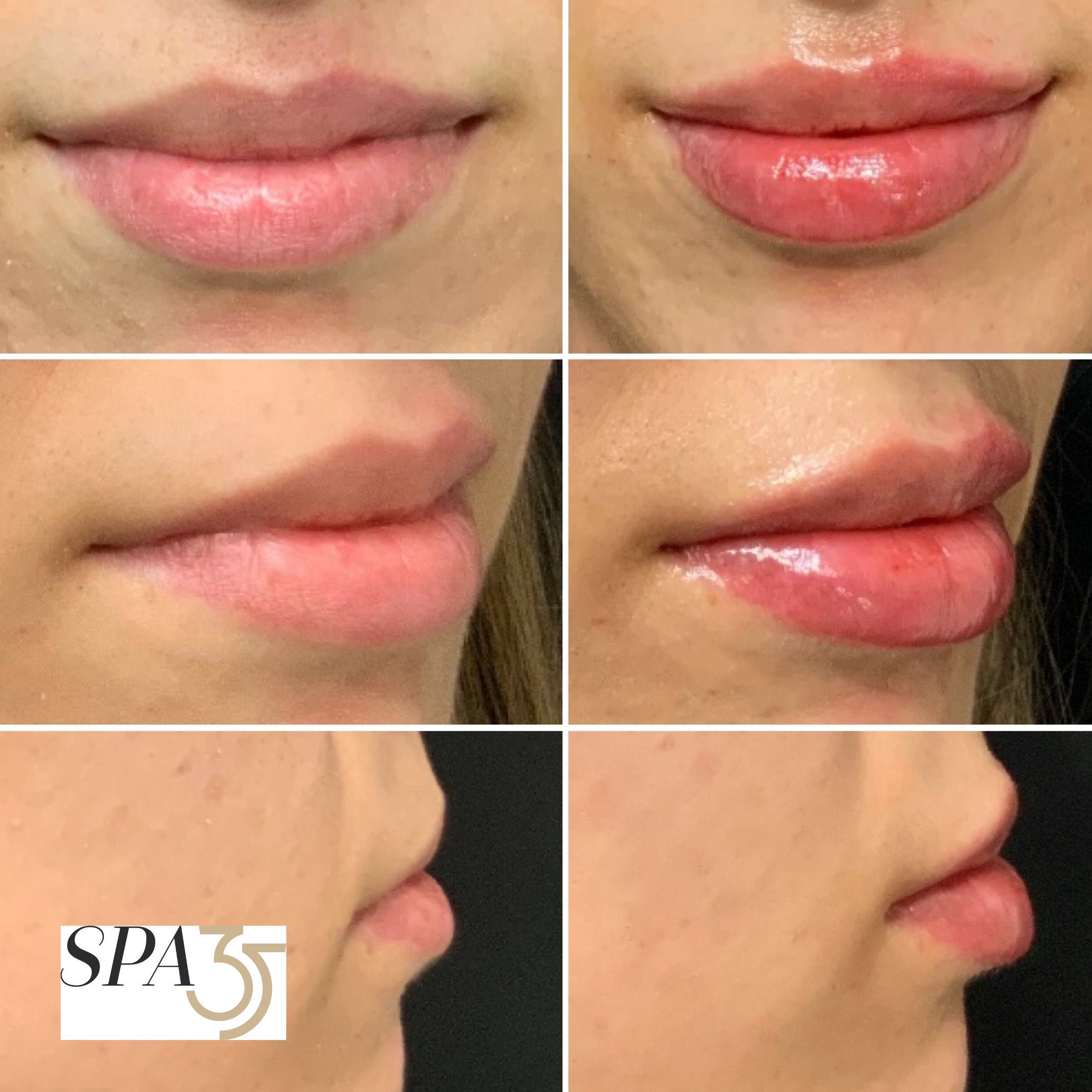 Lip Injections at Spa 35 