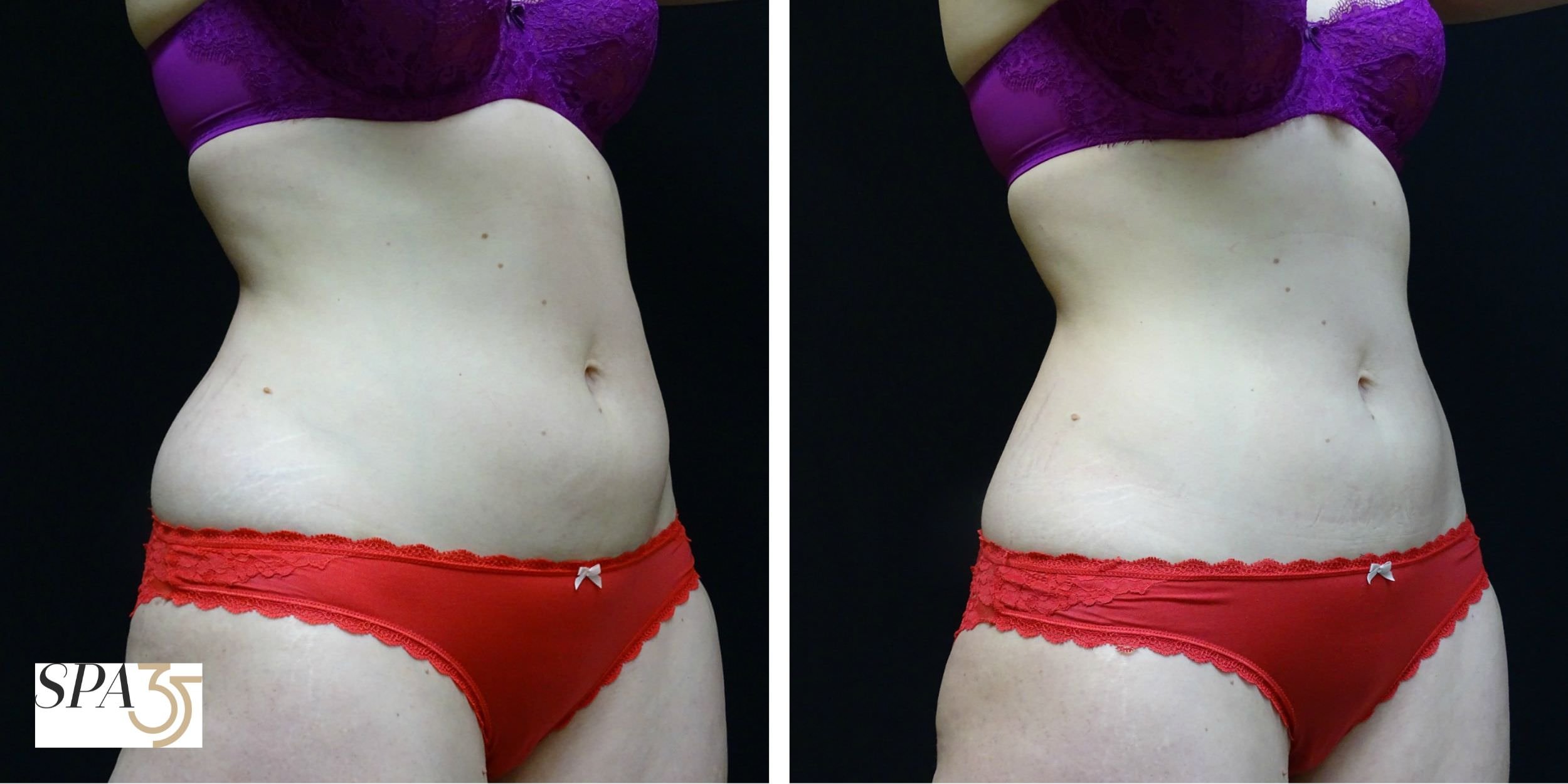 CoolSculpting Fat Removal Abdomen 45 Degree Before and After