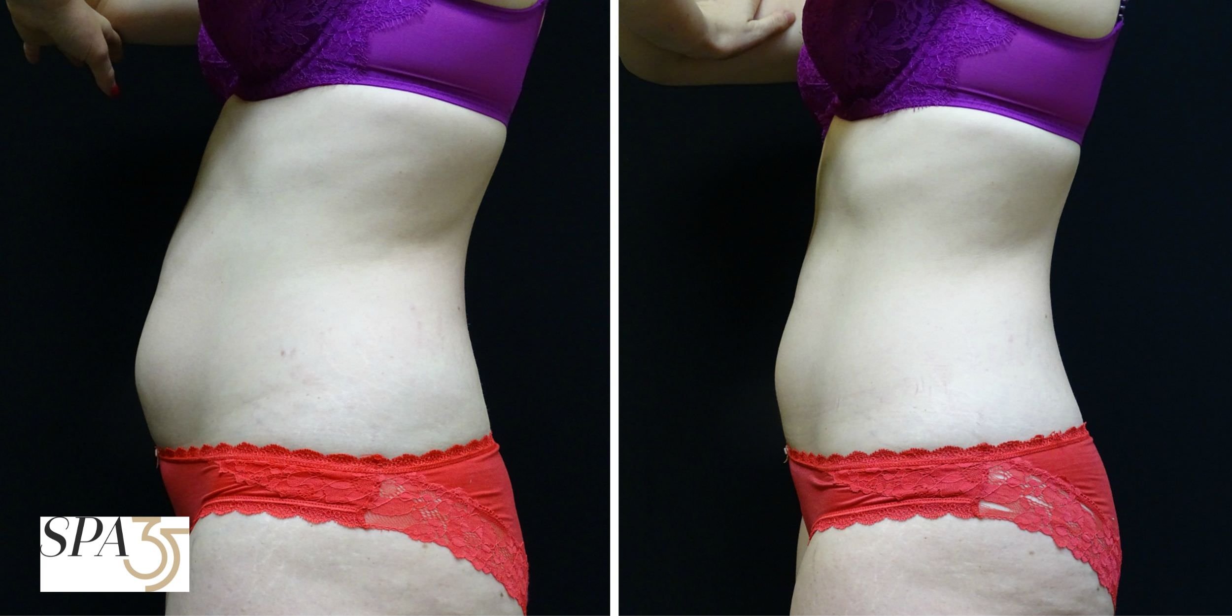 CoolSculpting Before and After Abdomen