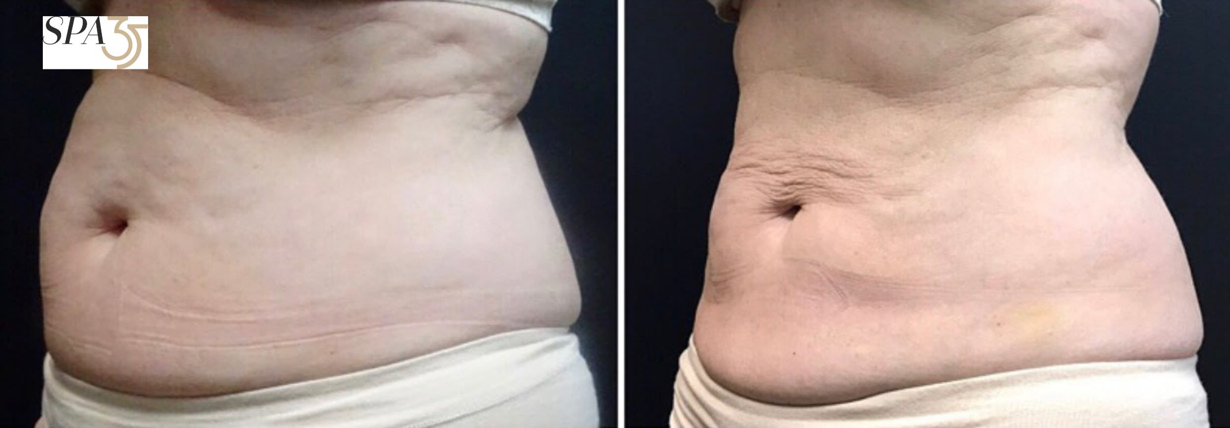 CoolSculpting Before and After - Abdomen