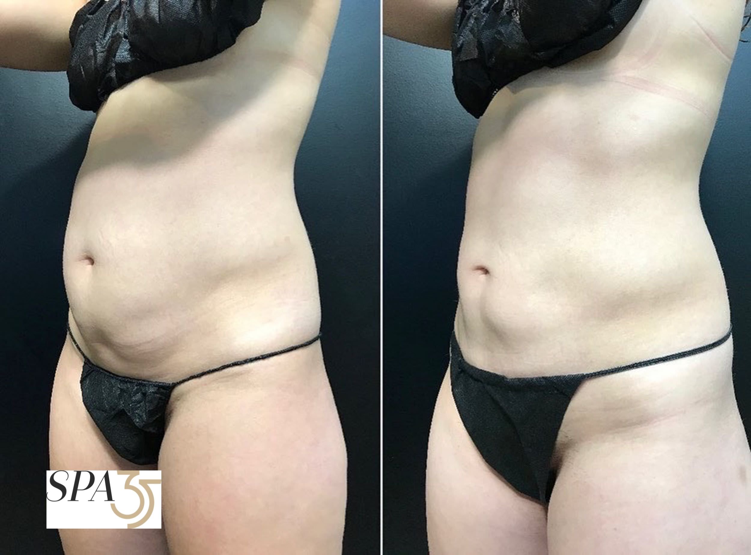 CoolSculpting Befoe and After Photo