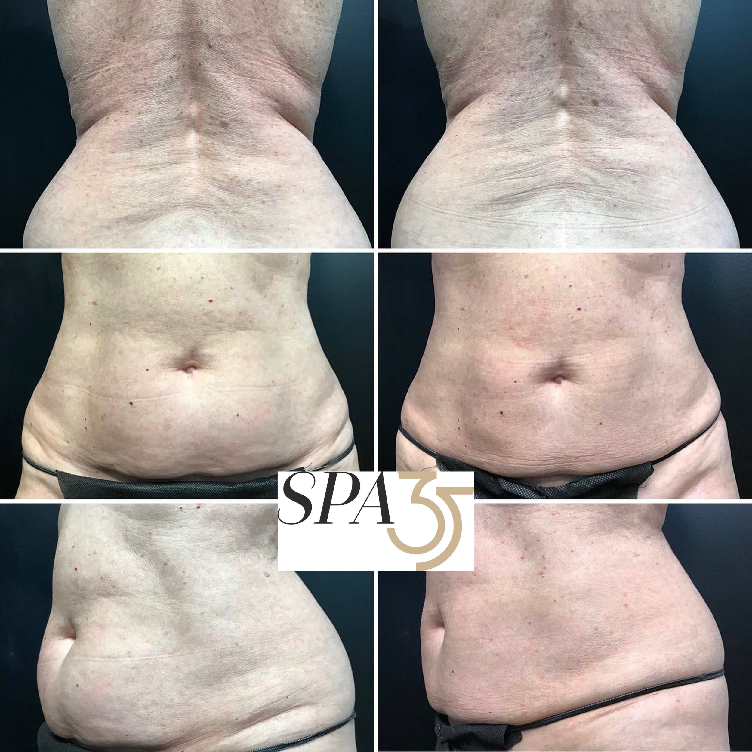 CoolSculpting Before and After Photos