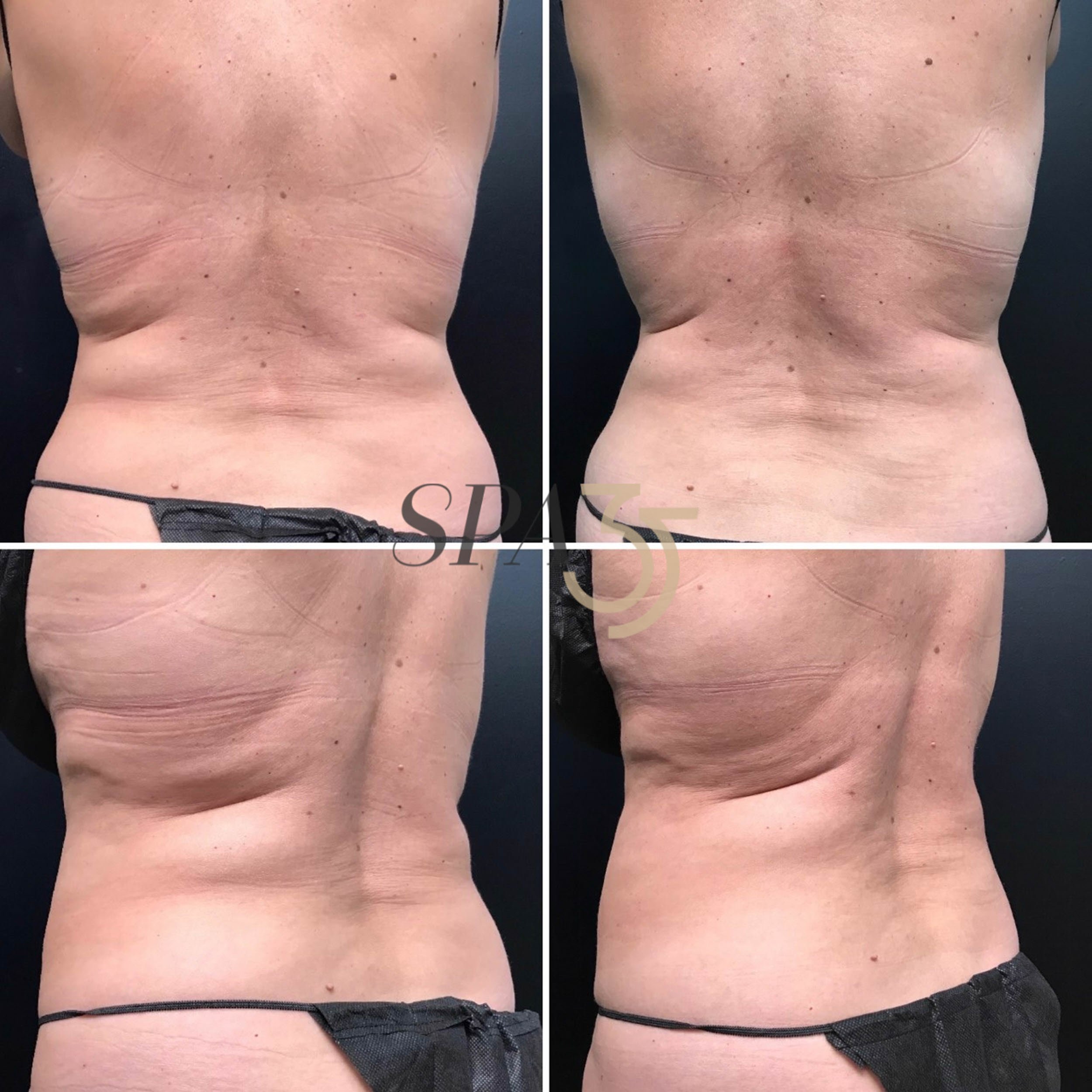 Love Handle Fat Removal - Spa 35 Client