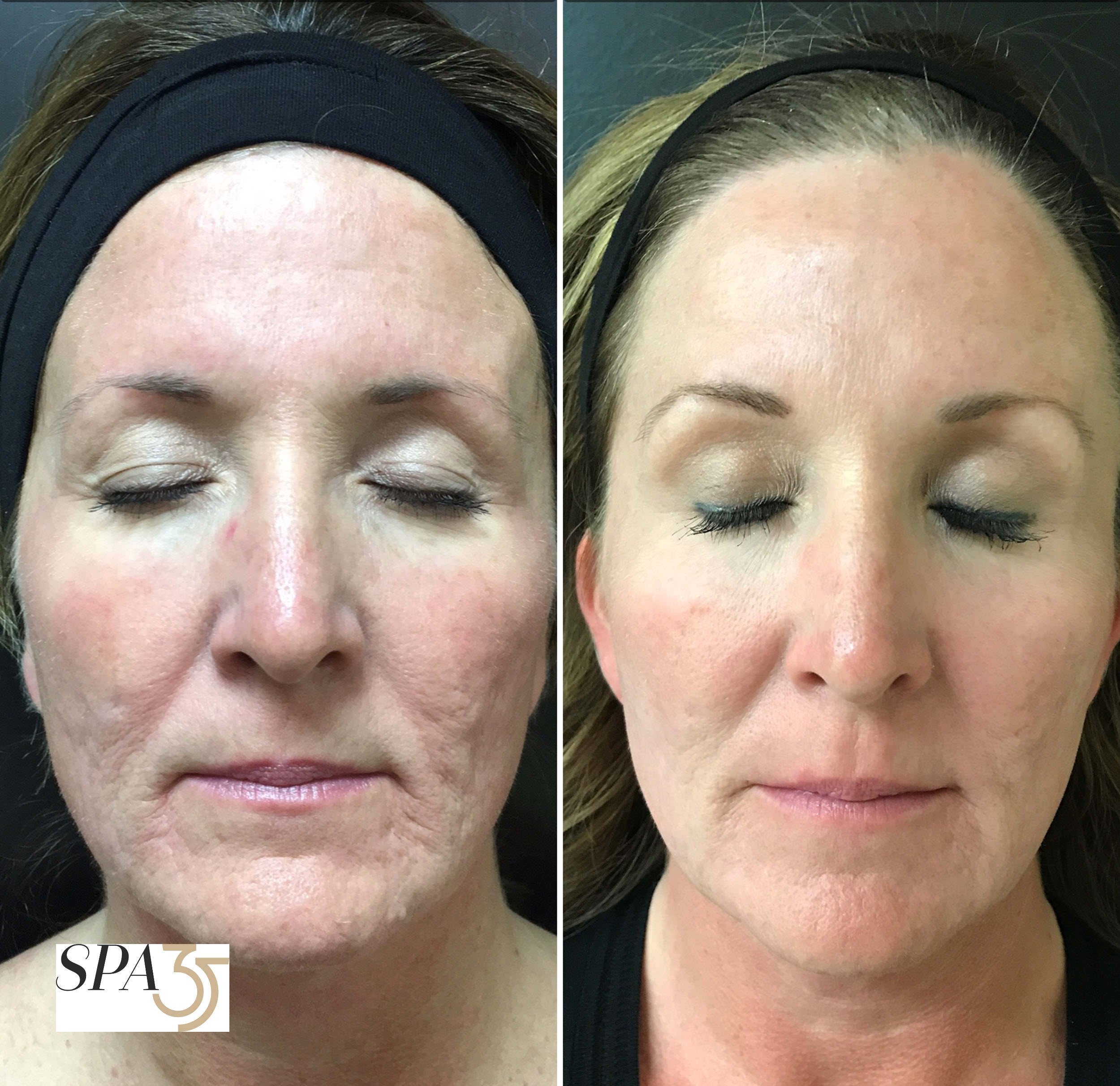 CO2 Laser Resurfacing Before and After Photo