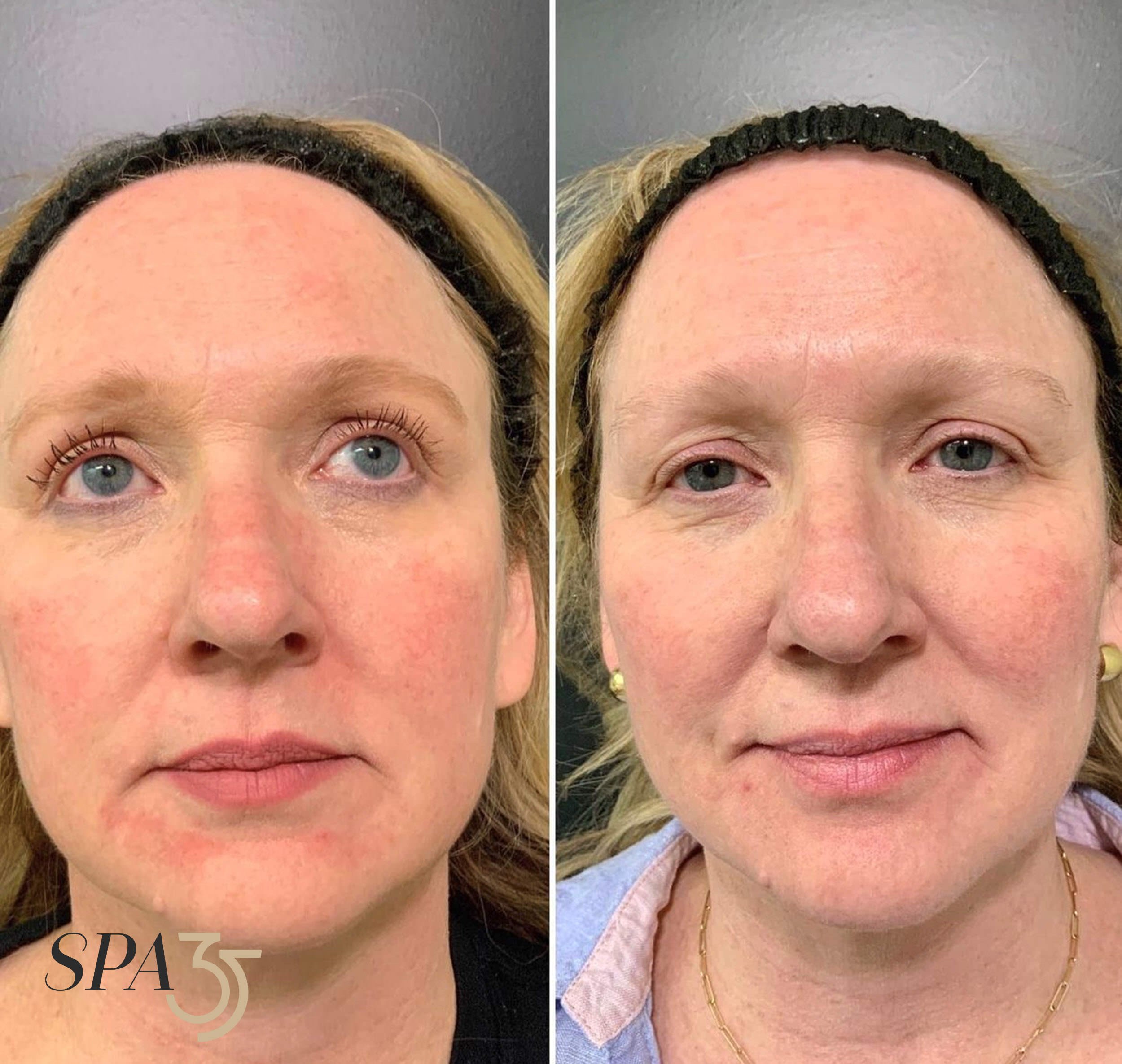 IPL/XPL - Remove Age Spots, Red Skin