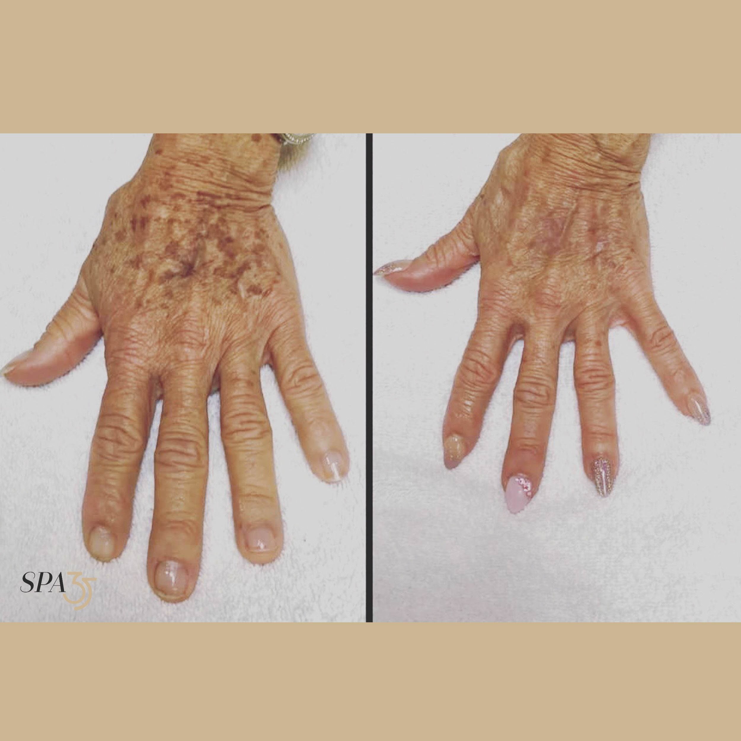 Intense Pulsed Light Hands Before and After Photo