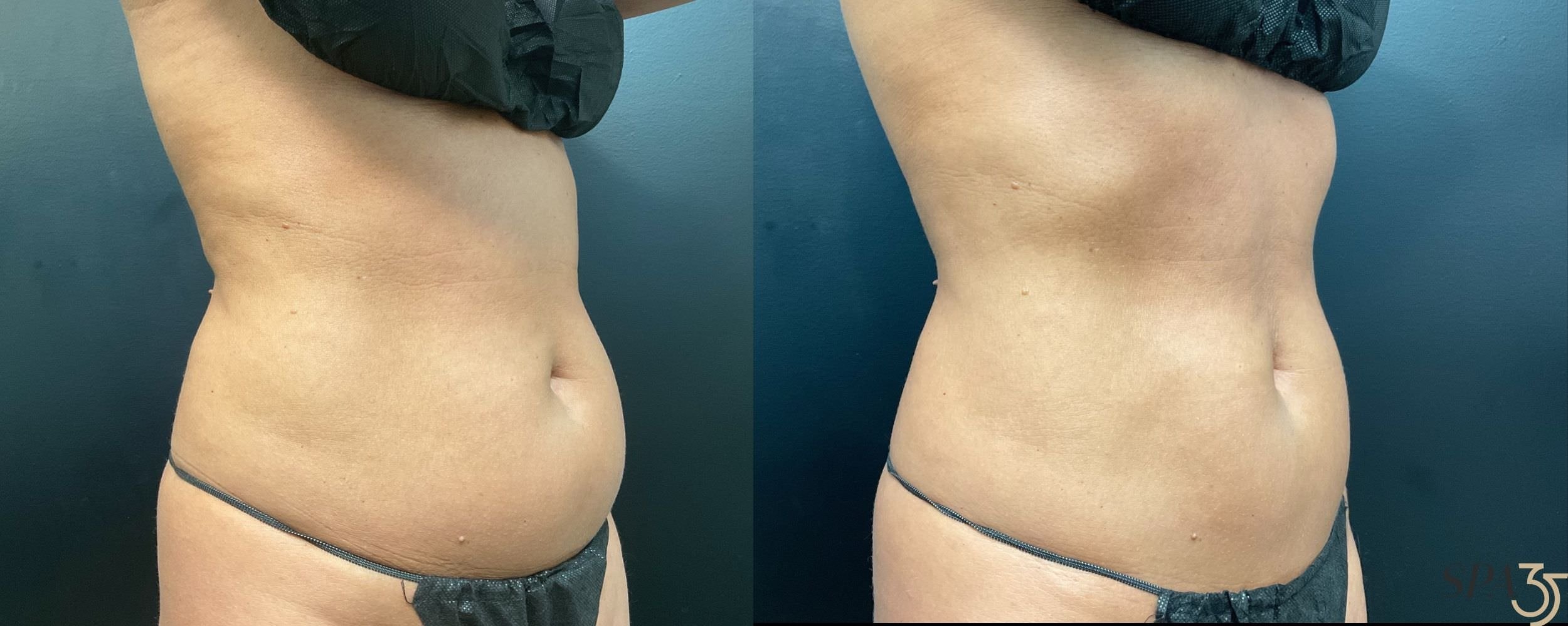 CoolSculpting Fat Removal Abdomen Before and After Photo - Spa 35.jpg