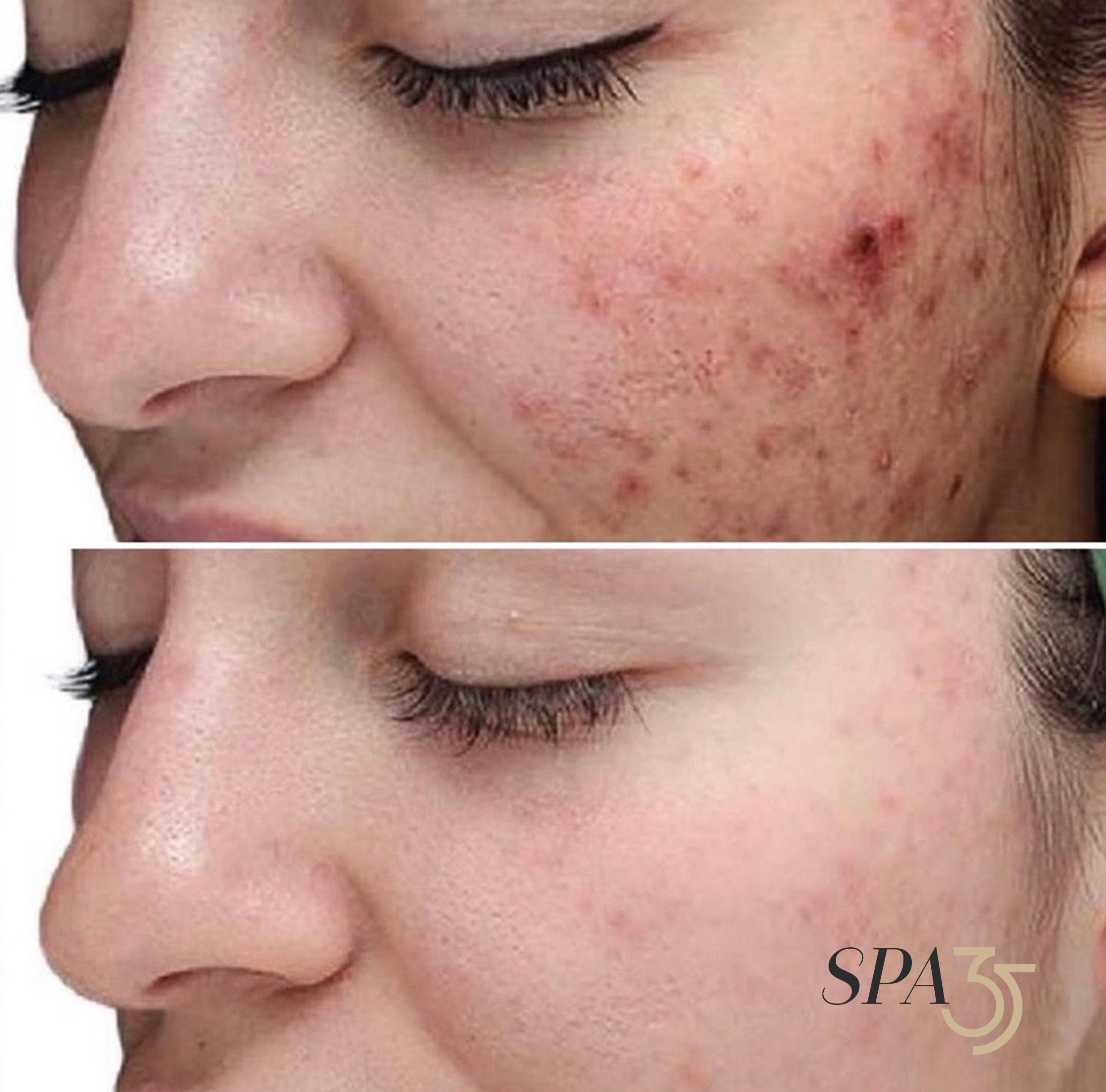 Chemical Peel Before and After photo at Spa 35 Medical Spa in Boise.jpg