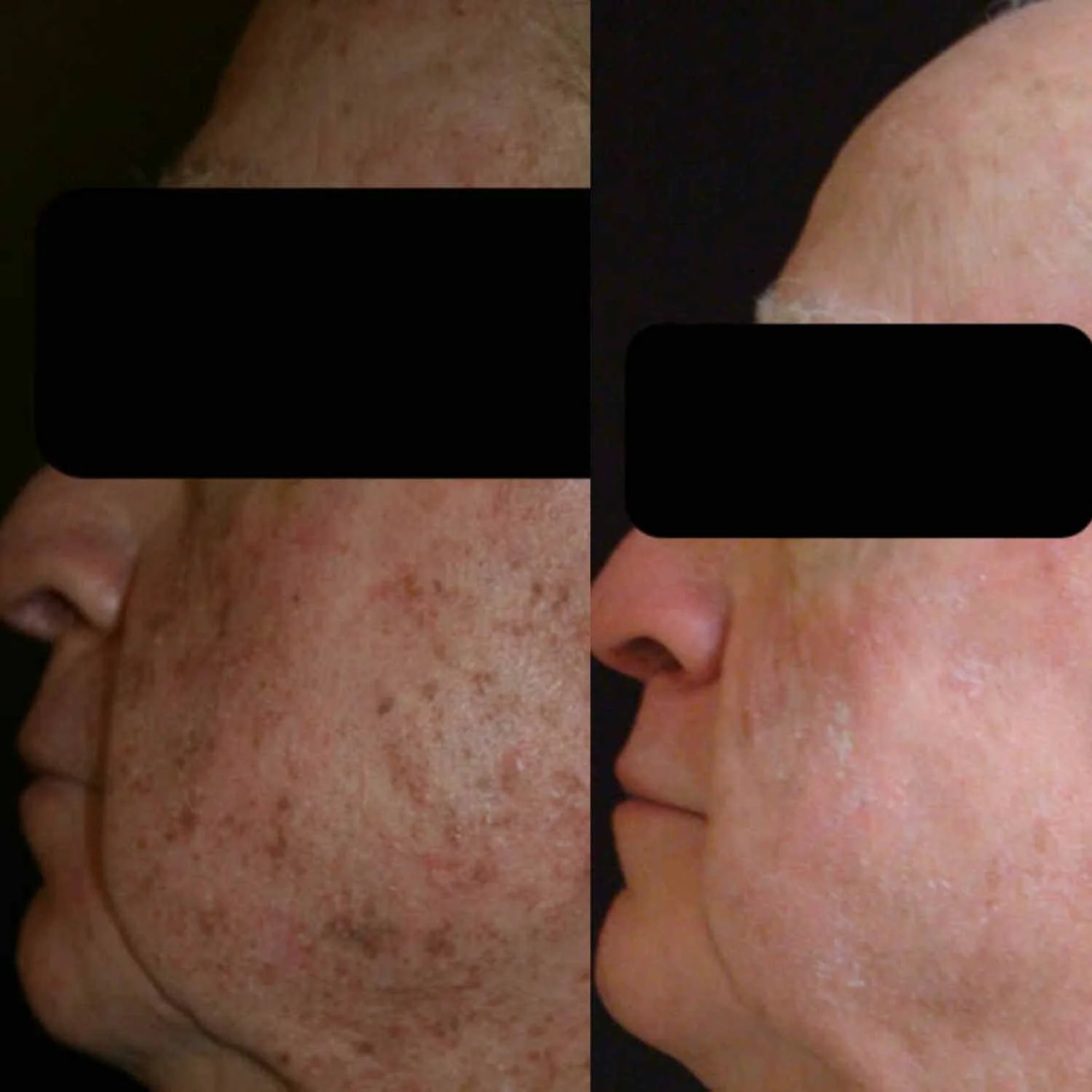 1500 x 1500 IPL Face before and after .jpg
