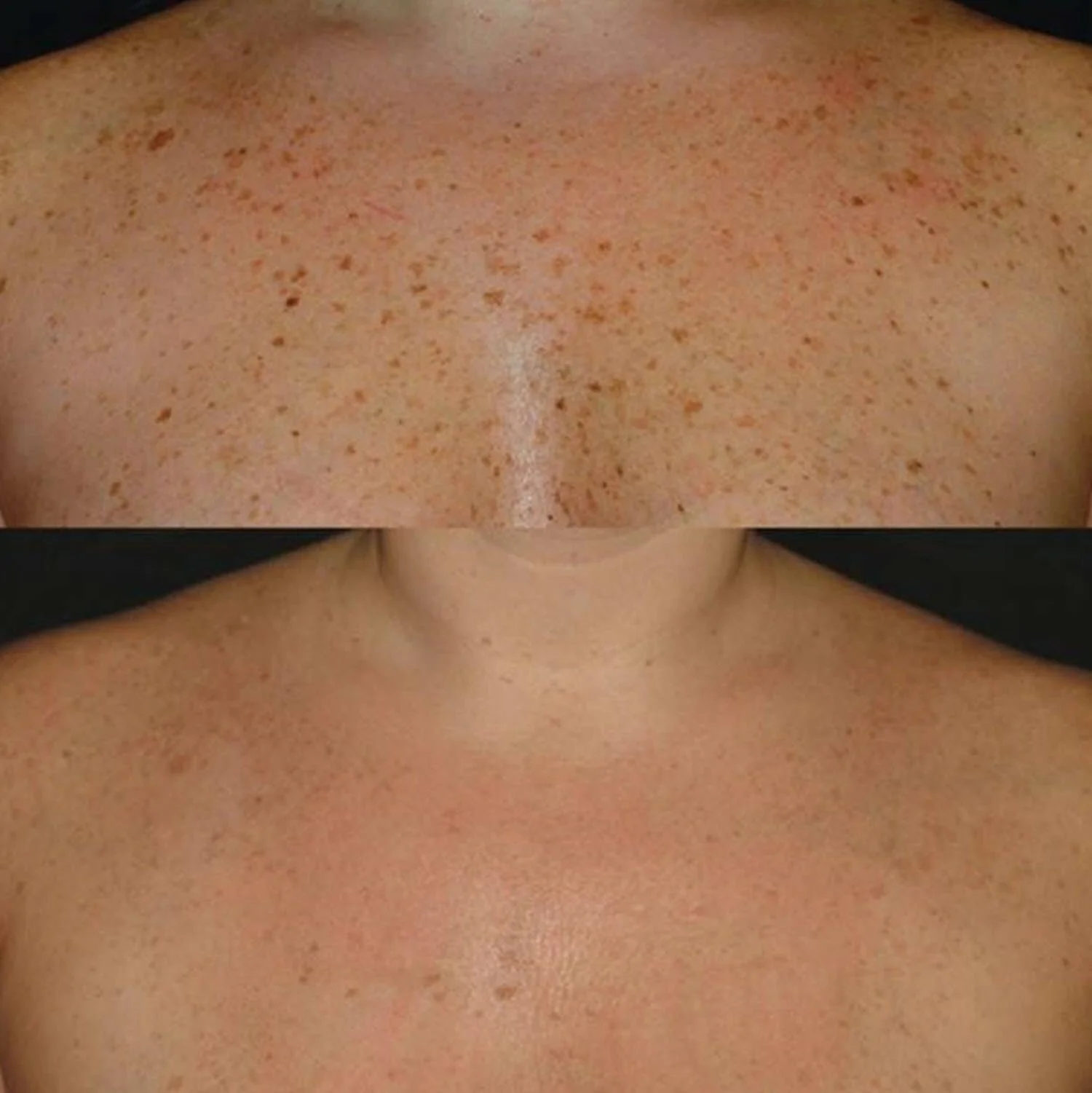 IPL Chest Before After Pictures Medical Spa Thirty Five Boise 1500 x 1500 x 96.jpg