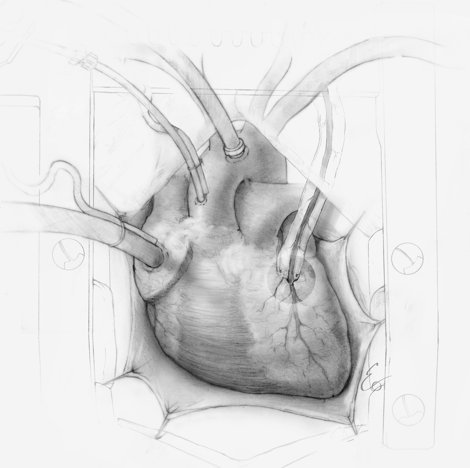 Coronary+bypass.jpg