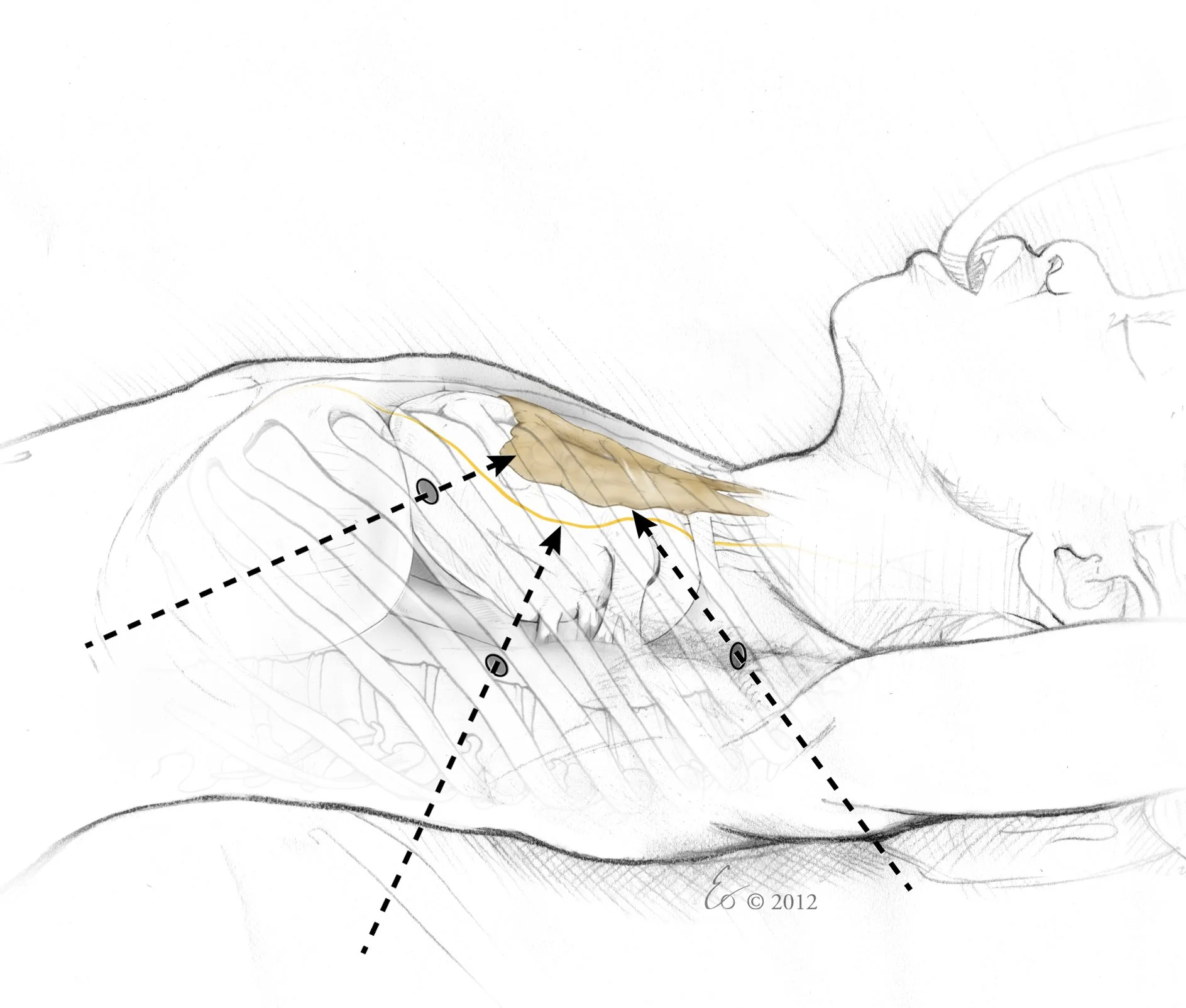 Thymectomy-Side-Fin.jpg