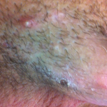 folliculitis pénisz merevedés van, de gyorsan elmúlik