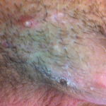 folliculitis pénisz