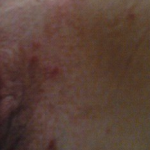 Folliculitis Std Triage App