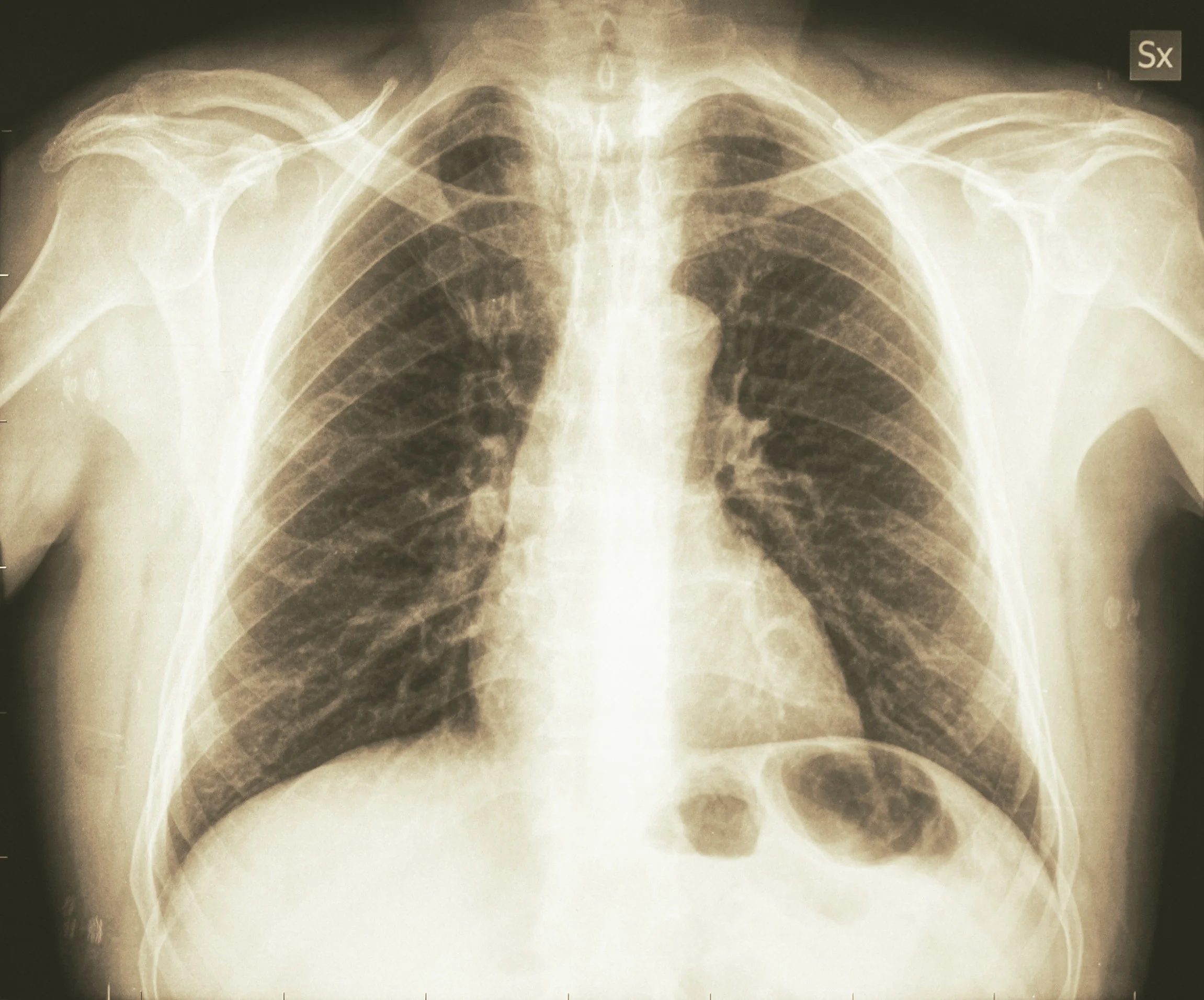 Applying X-Rays in Medicine