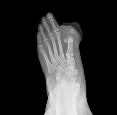 Diabetic Foot