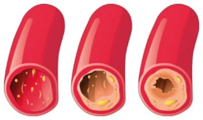 Peripheral Vascular Disease