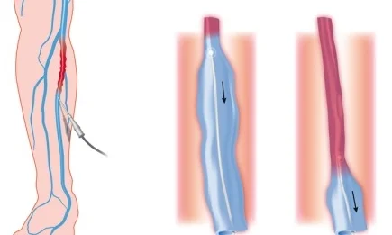 Endovenous Laser Therapy (EVLT®)
