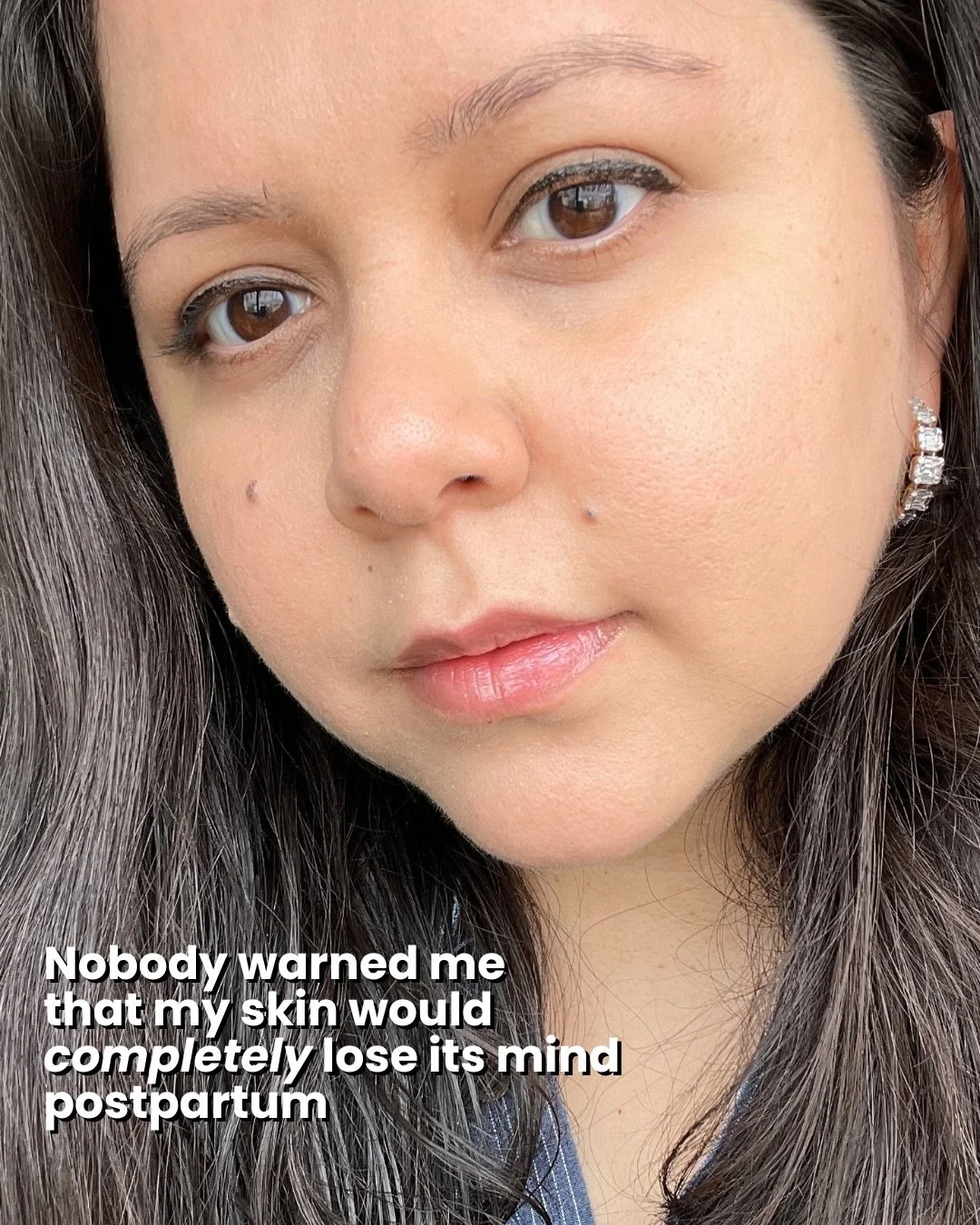 Postpartum skin is real. Here&rsquo;s what actually helped. //💛
&bull;&bull;&bull;
#postpartumjourney #skincarethatworks 

[caudalie salicylic acid spot treatment, azelaic acid serum for rosacea, moisture barrier, ceramides for dry skin, moisturizer