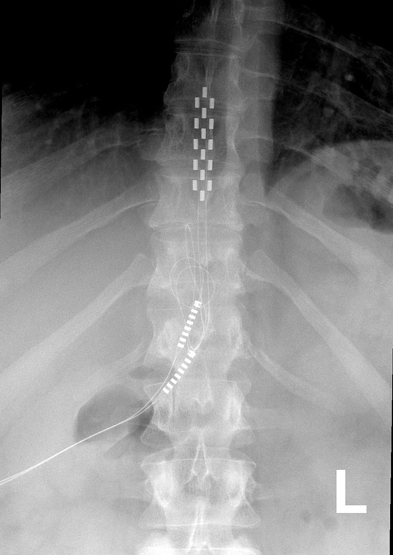 X-RAY OF PATIENT WITH MEDTRONIC SCS DEVICE