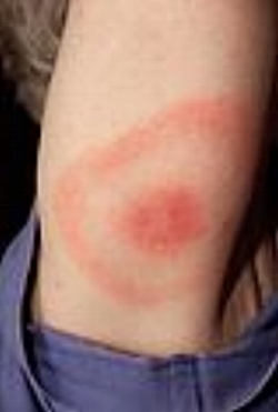 lyme disease rash