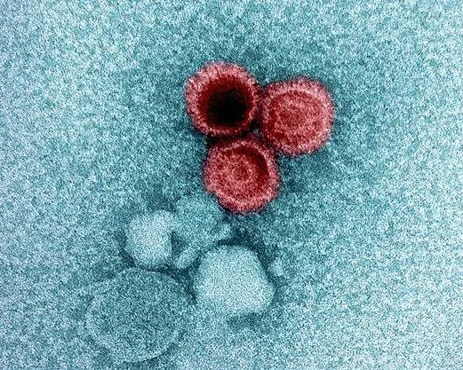 Lupus May Be Caused by Common Virus